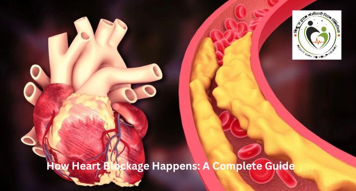 How Heart Blockage Happens: A Complete Guide